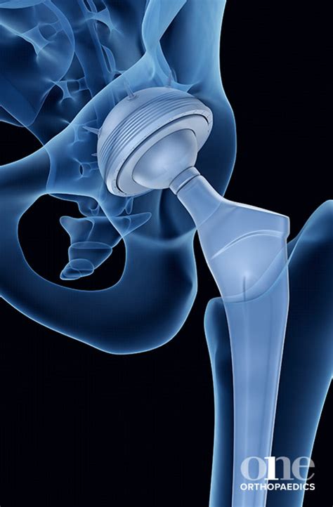 hip replacement aberdeen|private hip operation.